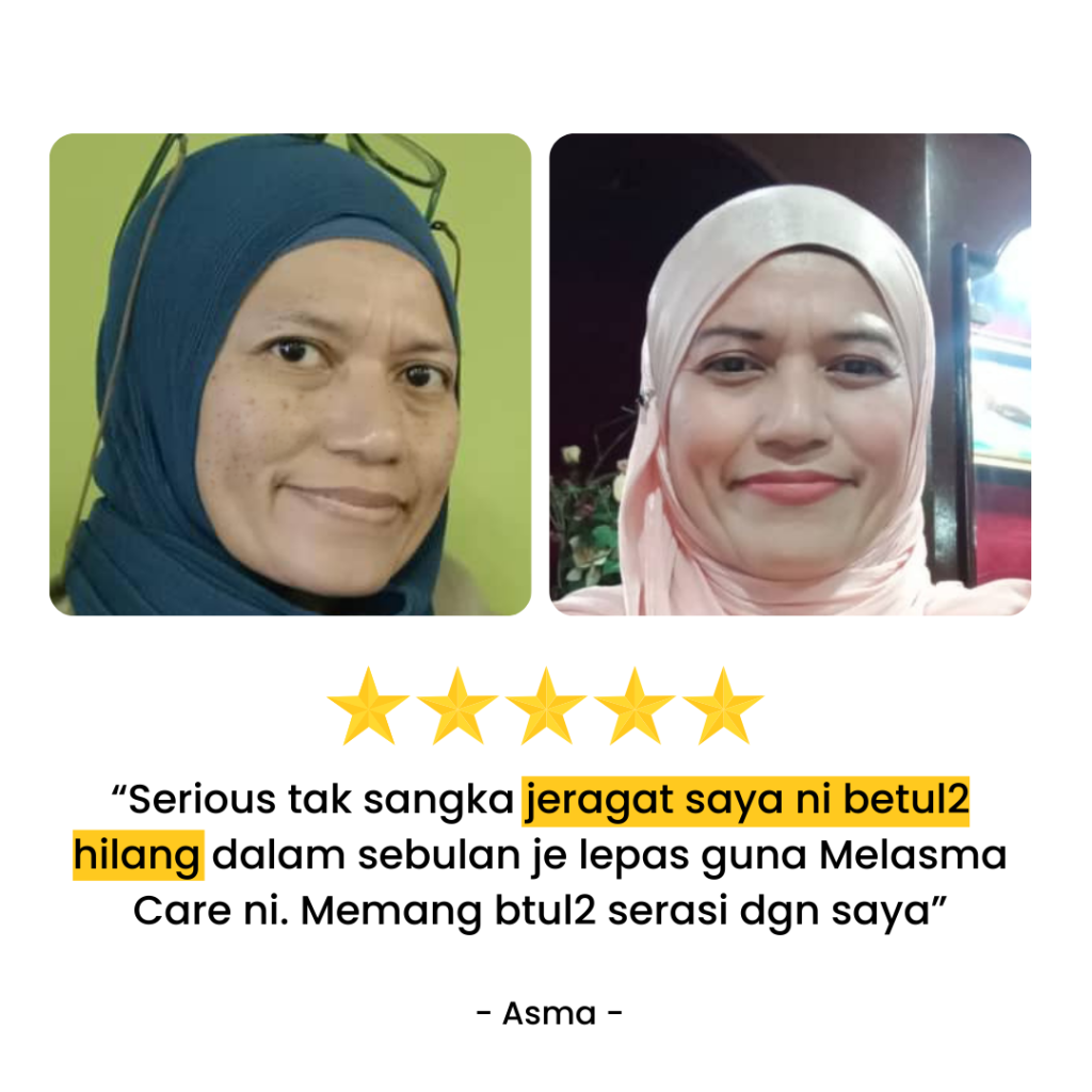 Melasma-Care-Testimoni-Pengguna