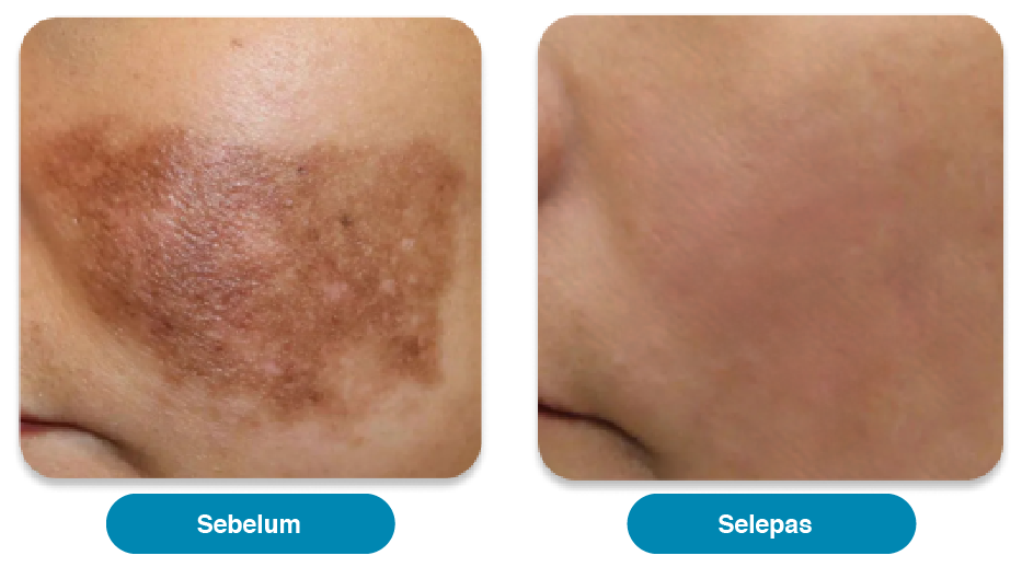 Melasma-care-before-after