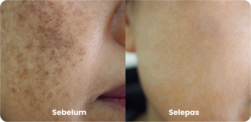 Melasma-care-before-after