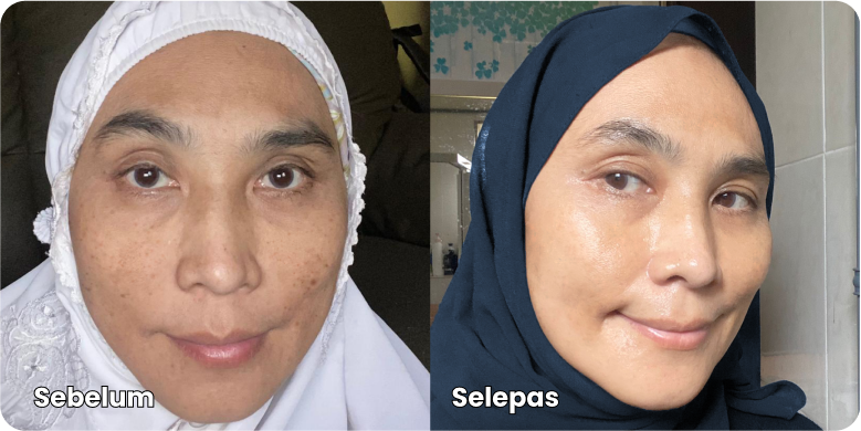 Melasma-Care-Testimoni-Pengguna