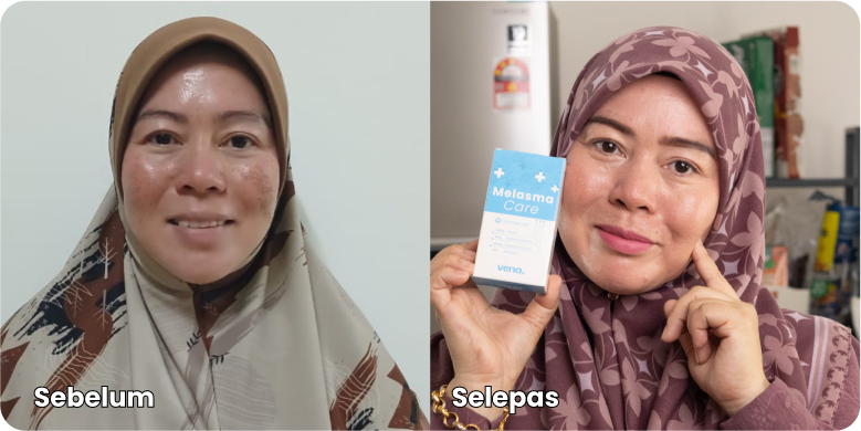 Melasma-Care-Testimoni-Pengguna