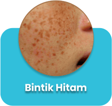 Melasma-care-cara-hilangkan-jeragat