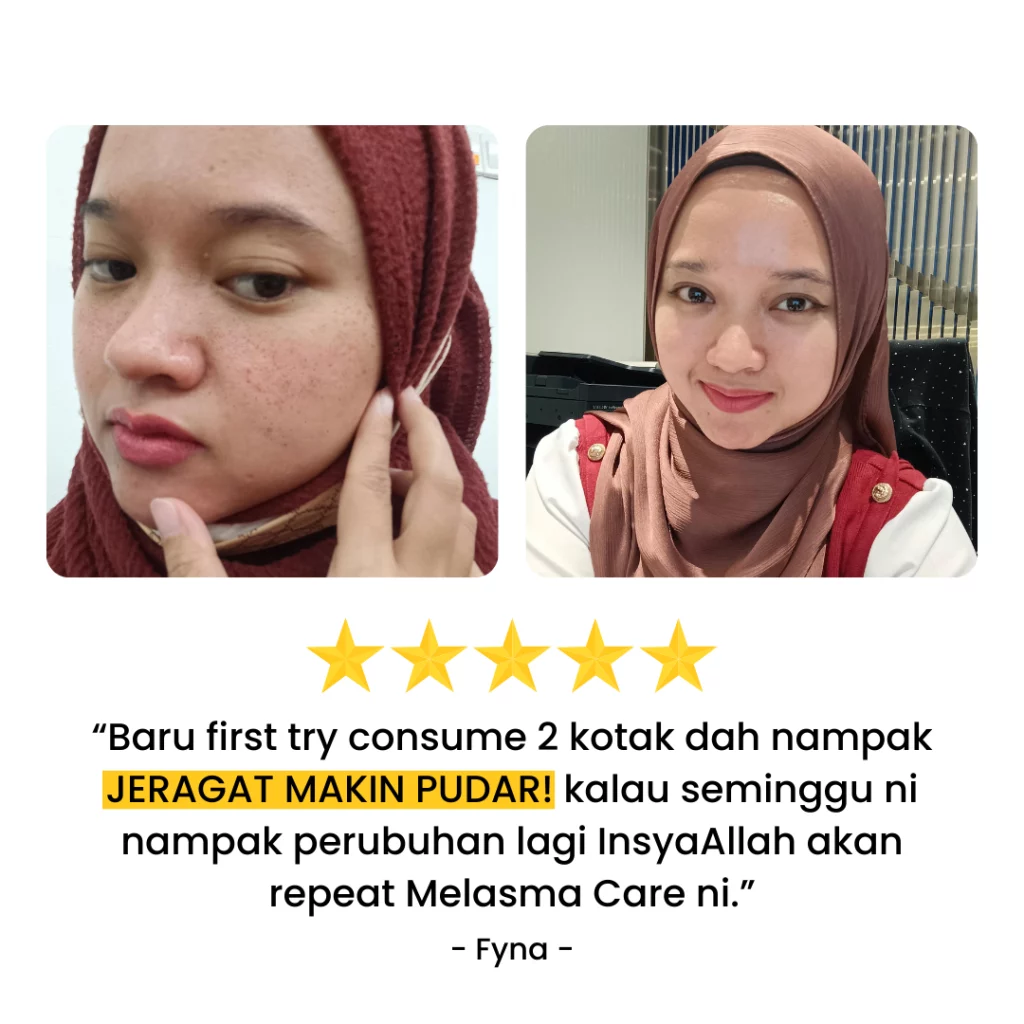 Melasma-Care-Testimoni-Pengguna