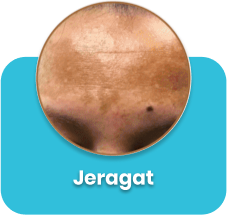 Melasma-care-cara-hilangkan-jeragat