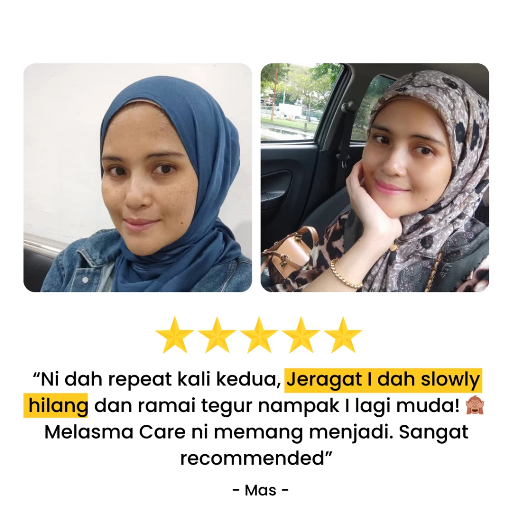 Melasma-Care-Testimoni-Pengguna