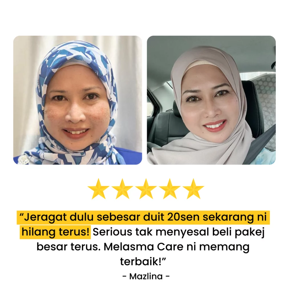 Melasma-Care-Testimoni-Pengguna