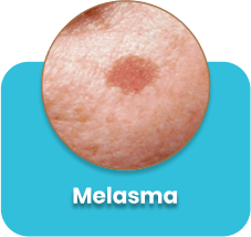 Melasma-care-cara-hilangkan-jeragat